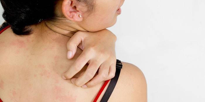 Холодовий дерматит - симптоми алергії і лікування мазями і народними засобами