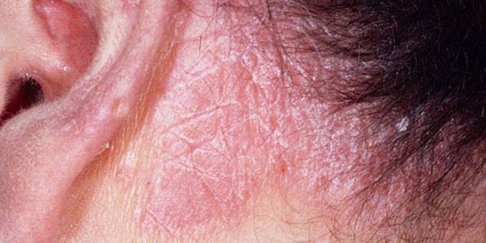 Лікування себорейного дерматиту шкіри голови шампунями, ліками і народними засобами