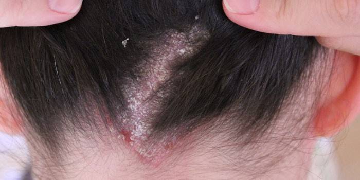 Себорейний дерматит волосистої частини голови: лікування в домашніх умовах