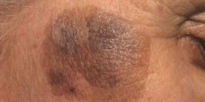 Себорейний кератоз: як лікувати шкіру