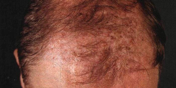 Фавус волосистої частини голови - парша: симтоми та діагностика