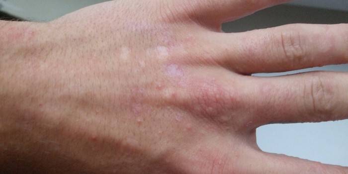 Пухирі на пальцях рук - причини появи водянистих шкірних висипань і лікування