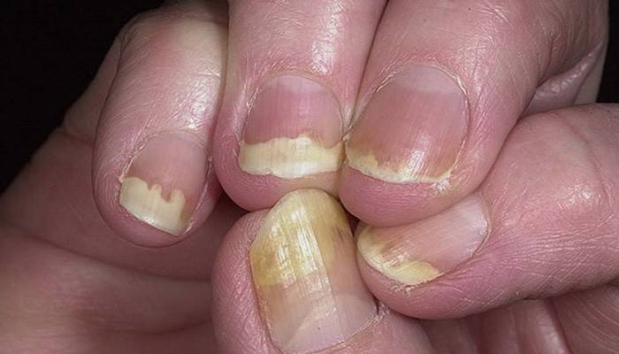 Псоріаз нігтів на ногах і руках: симптоми і лікування в домашніх умовах