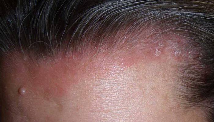 Псоріаз на голові:засоби для лікування шкіри в домашніх умовах