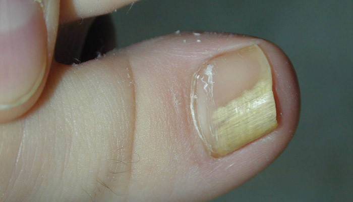 Дріжджовий грибок на шкірі і нігтях у жінок, чоловіків і дітей: симптоми і лікування