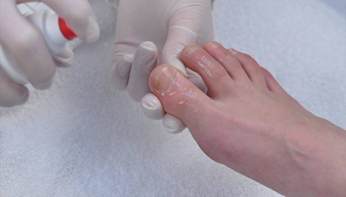 Лікування грибка на великому пальці ноги: ефективні методи