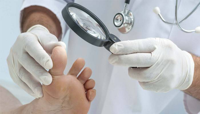 Лікування грибка між пальцями ніг народними засобами: ефективні способи