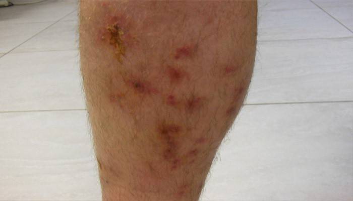 Бешихове запалення шкіри ноги і руки: симптоми і лікування в домашніх умовах