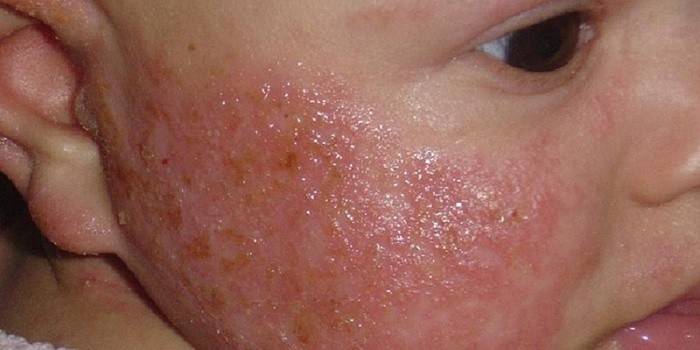 Червоні плями на тілі дитини: алергічні, чешущиеся і шорсткі