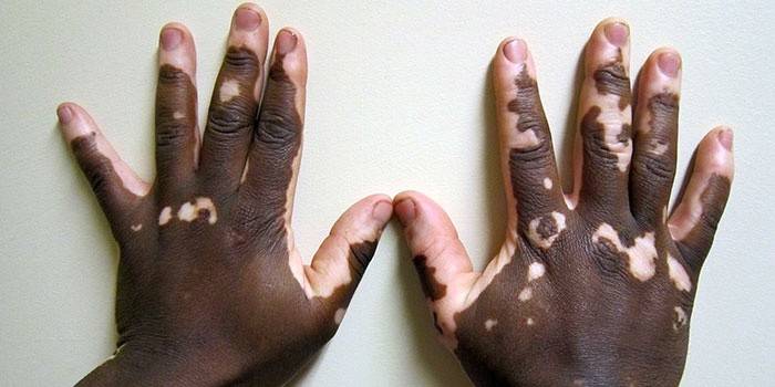 Хвороба вітіліго: причини, симптоми і лікування білих плям на шкірі