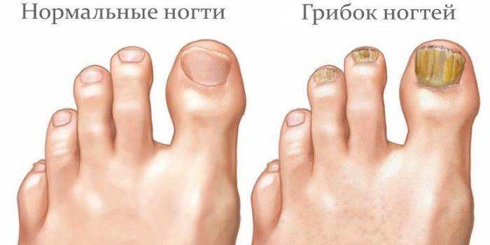Грибок нігтів на ногах - як лікувати в домашніх умовах: ефективні препарати при захворюванні, профілактика оніхомікозу