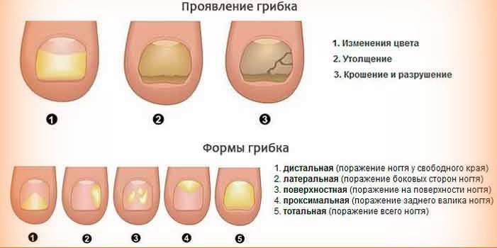 Лікування грибка нігтів швидкими способами: народні засоби, ефективні методи і препарати