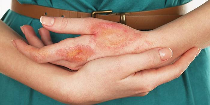 Герпес на руці: причини та особливості зараження, діагностика і лікування