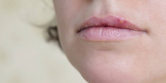 Герпес на губах під час вагітності - симптоми і методи позбавлення медикаментами або народними рецептами