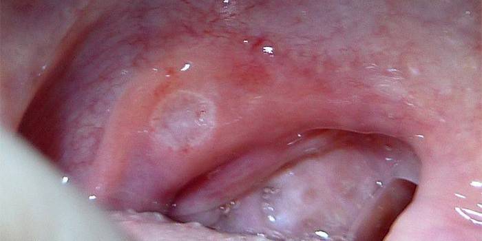 Білий наліт на губах - чому з'являється вранці, в куточках або всередині рота, діагностика і засоби терапії