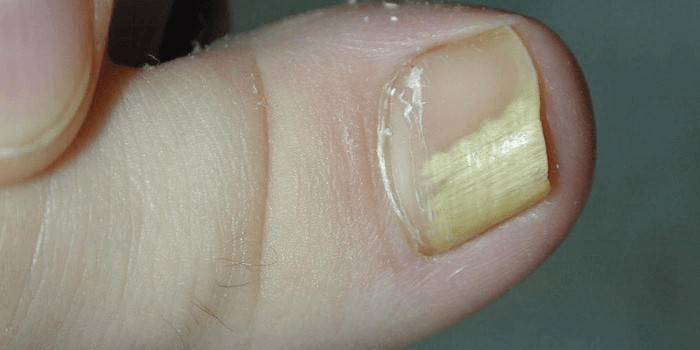 Грибкові захворювання нігтів: лікування оніхомікозу