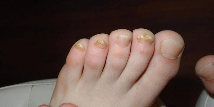 Хвороби нігтів на ногах у дітей і дорослих - перелік і симптоматика, причини появи й опис