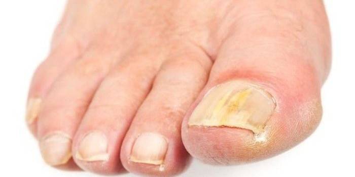 Що таке грибок нігтів на ногах - як виглядає та види захворювання, симптоми і засоби терапії