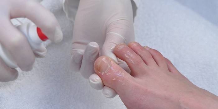 Як швидко вилікувати грибок нігтів на ногах - рецептами народної медицини і лікарськими препаратами