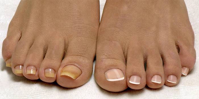 Як позбутися від грибка нігтів: причини, симптоми і лікування захворювання народними засобами і препаратами, відгуки