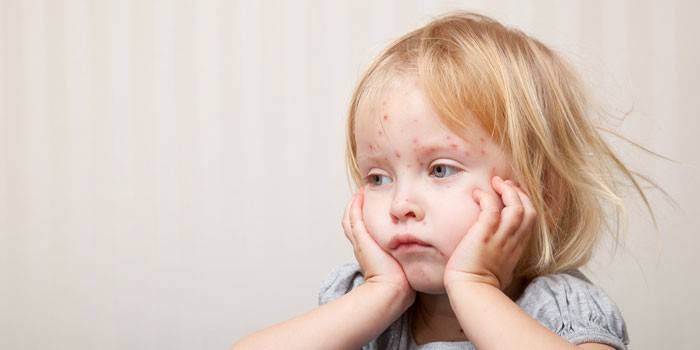Краснуха - симптоми хвороби, профілактика для дітей і дорослих