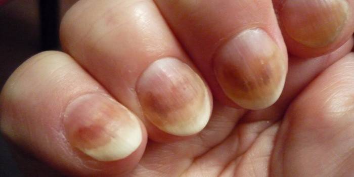 Як виглядає грибок нігтів: стадії визначення хвороби