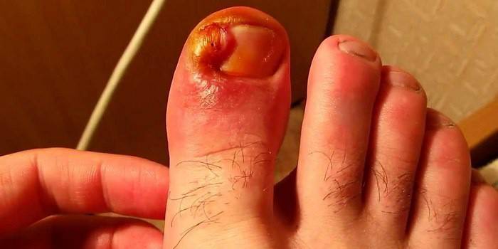 Видалення нігтя на великому пальці ноги - 3 методу