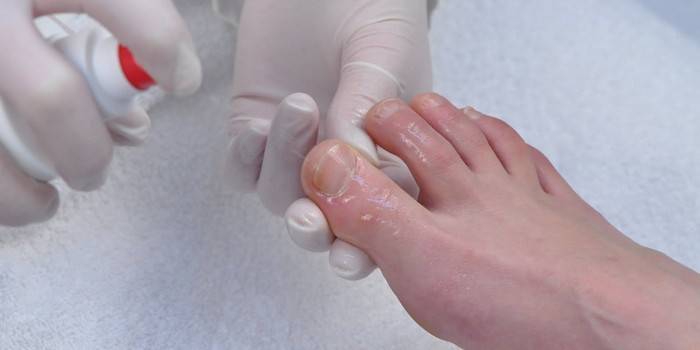 Краплі від грибка нігтів на ногах: протигрибкові препарати для лікування