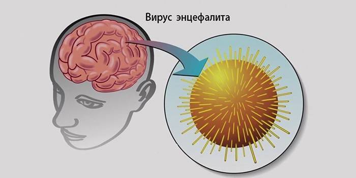 Енцефаліт головного мозку: лікування і наслідки ураження вірусом