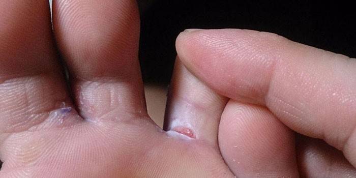 Тріщини на пальцях ніг - чому з'являються, як лікувати рани препаратами і народними засобами, профілактика ураження шкіри