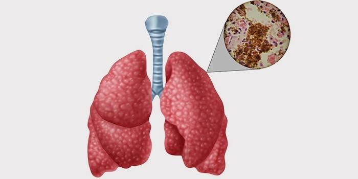 Лікування туберкульозу легень у дорослих і дітей народними засобами