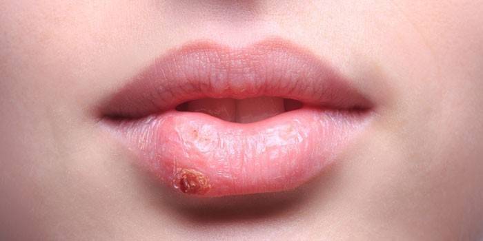 Чим лікувати застуду на губах в домашніх умовах: причини герпесу, ефективні ліки і народні засоби від вірусу, ціни препаратів