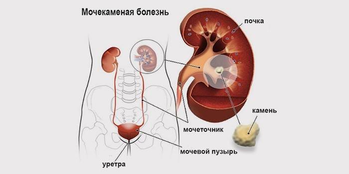 Дієта при каменях у нирках: правильне харчування при захворюванні