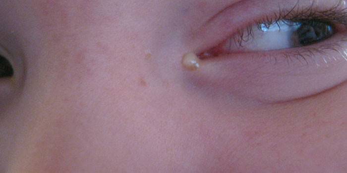 Білі виділення в кутках очей у дитини і дорослого: від чого з'являється наліт, медикаментозні і народні засоби від слизу і інфекції