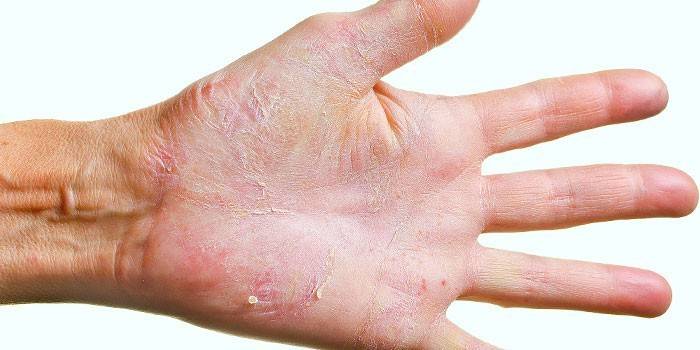 Кращі народні засоби від грибка на руках: як швидко позбутися від інфекції на шкірі, нігтях та між пальцями