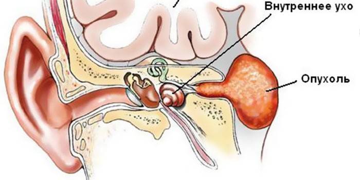 Невринома слухового нерва: симптоми, лікування