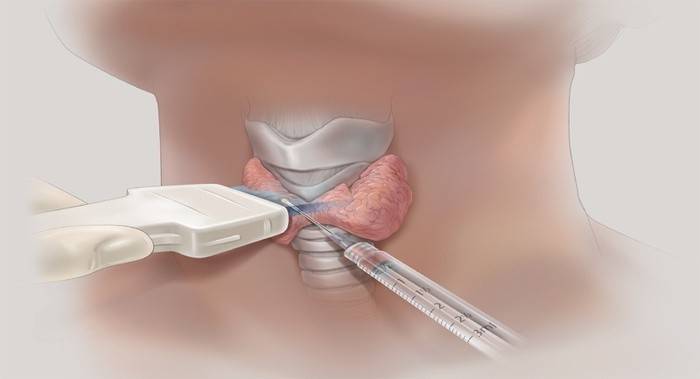 Пункція щитовидної залози і біопсія для лікування щитовидки