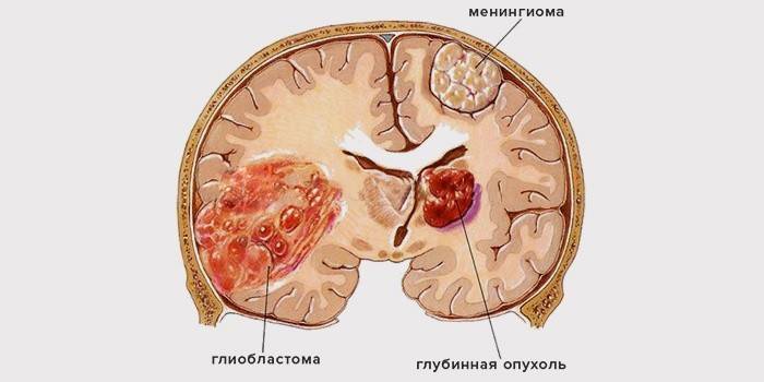 Глиобластома головного мозку: ступені та симптоми, причини та лікування пухлини