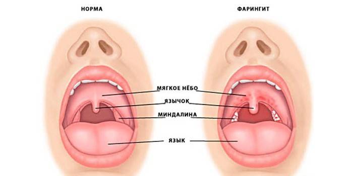 Біль у горлі при ковтанні: причини і лікування