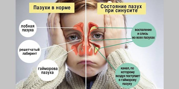 Закладений ніс у дитини - перші ознаки, лікарська терапія, народні засоби, інгаляції і промивання