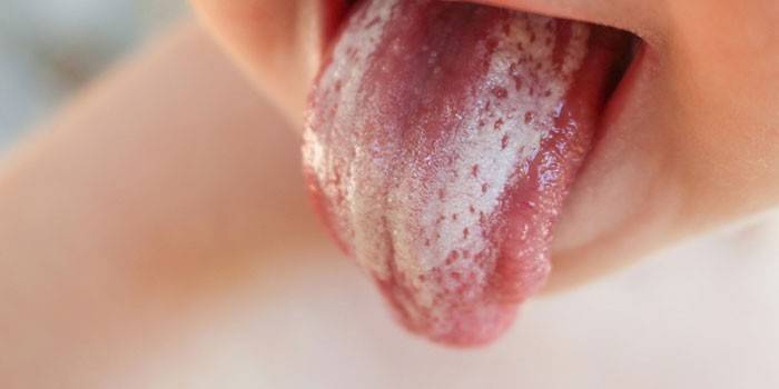 Наліт на язиці у дитини йди дорослого, як симптом захворювання - чому з'являється і як позбутися