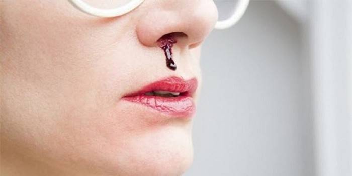 Чому йде кров з носа у дитини, чоловіка або жінки - як зупинити