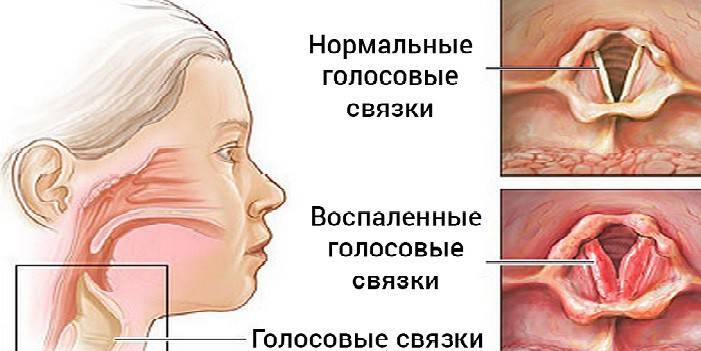 Пропав голос: як лікувати горло дітям і дорослим