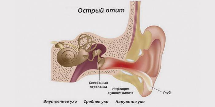 Запалення вуха: симптоми і ознаки, причини хвороби, діагностика і лікування захворювання