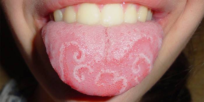 Запалення мови: симптоми, причини та лікування слизової