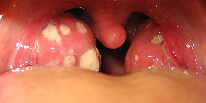 Збільшені мигдалини в горлі у дитини і дорослого: причини і лікування