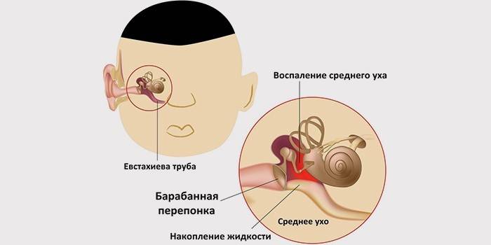 Отит середнього вуха – симптоми і лікування ексудативного, гострого і хронічного