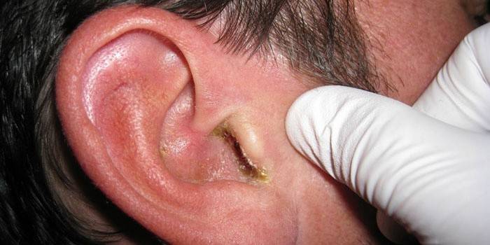Лікування отиту у дорослих гнійного та середнього вуха в домашніх умовах
