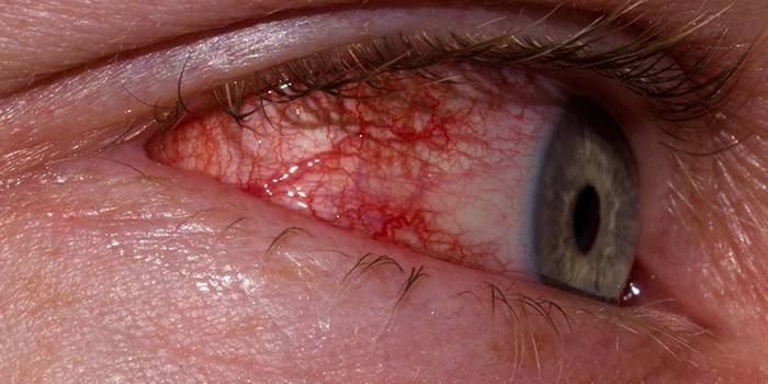 Хламідіоз очей - шляхи передачі інфекції, медикаментозна терапія і засоби народної медицини