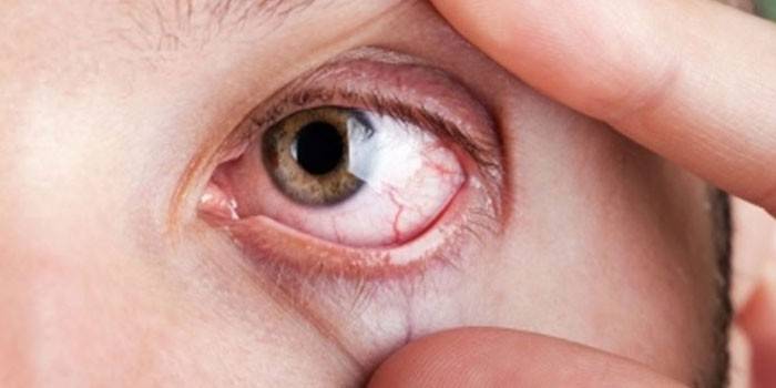 Грибкова інфекція очей: види уражень і препарати від грибка